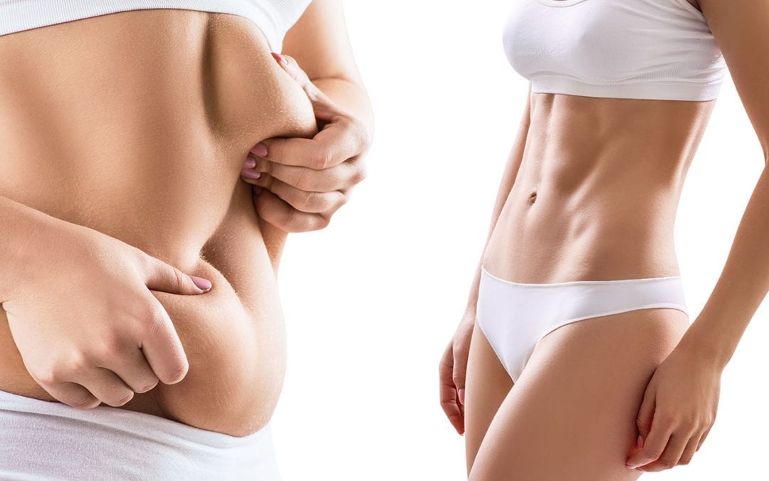 Liposuction – Some common misconceptions