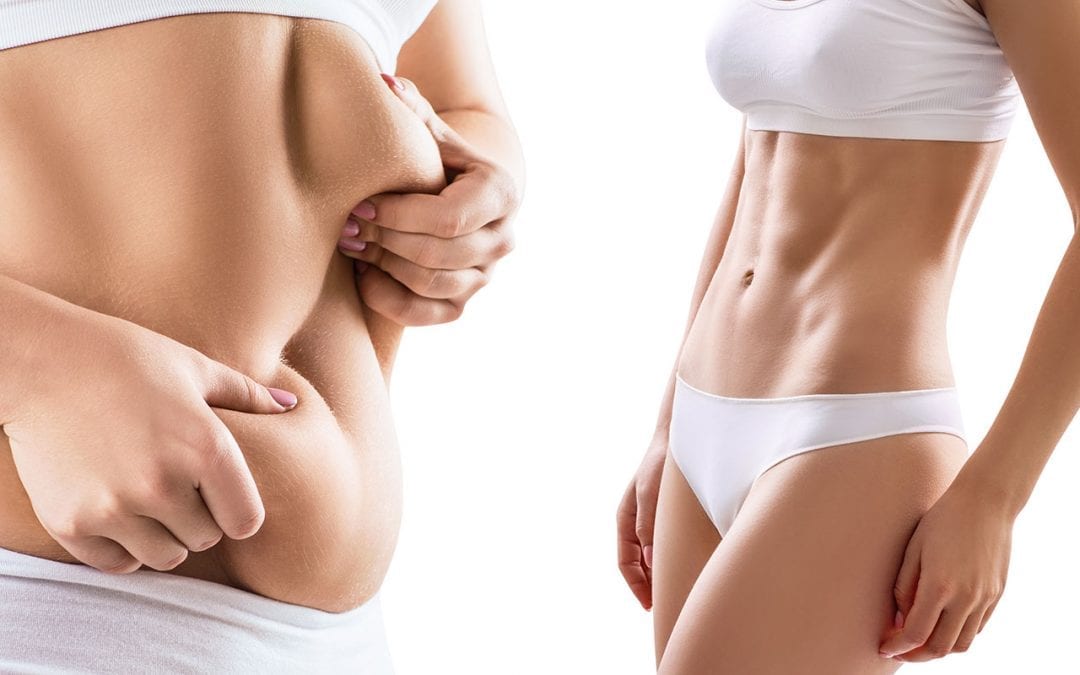 Liposuction – Some common misconceptions | Effie Katerinaki