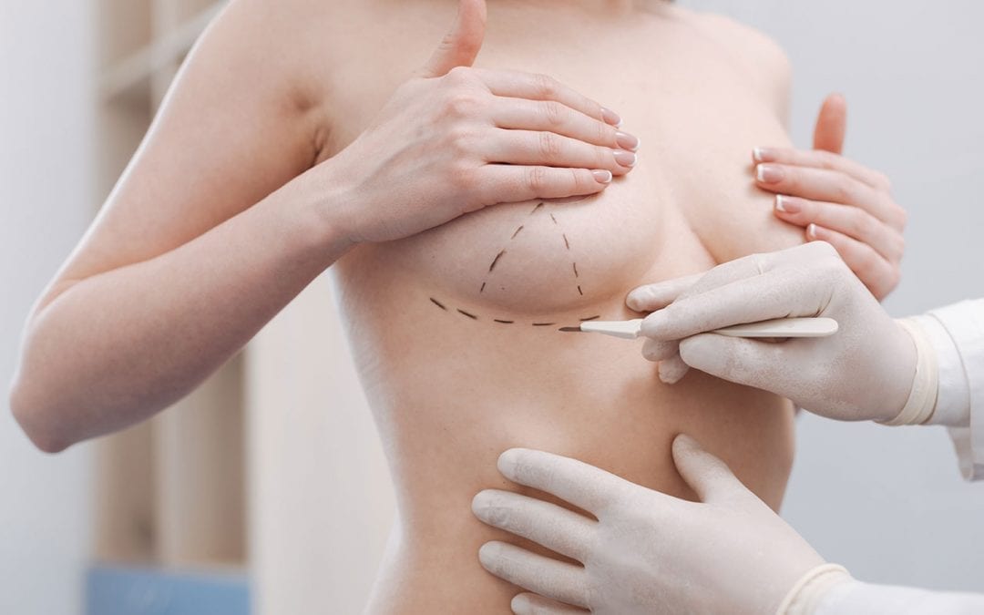 Mastopexy (Breast uplift) – how long will the result last?